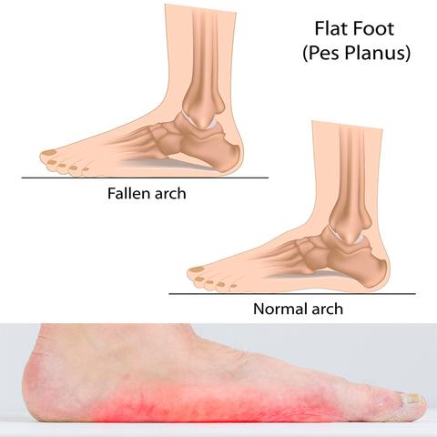 Arch Support Gel